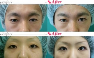 日本黑科技双眼皮 美人计｜不用开刀埋线，单眼皮变双眼皮神器你知道几种？